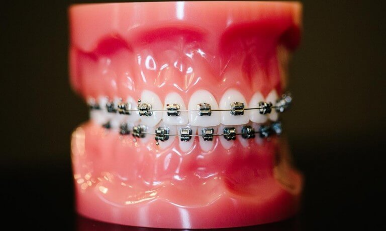 Braces11 - Farmington Dental & Orthodontics