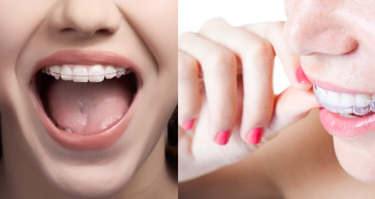 Invisalign (Clear Aligner) Braces Before and After: 3M Clarity